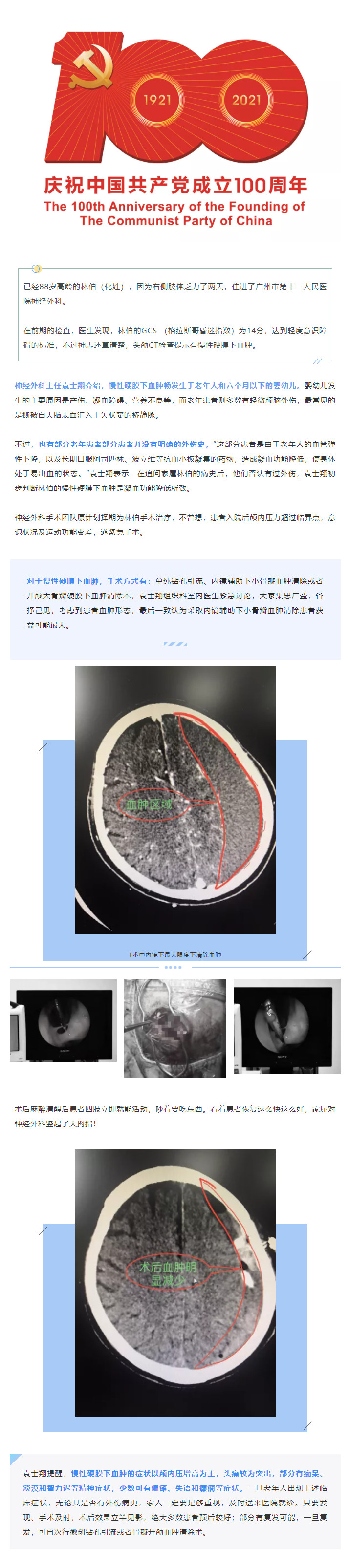 关于慢性硬膜下血肿，家里老人出现这些症状要当心！.jpg