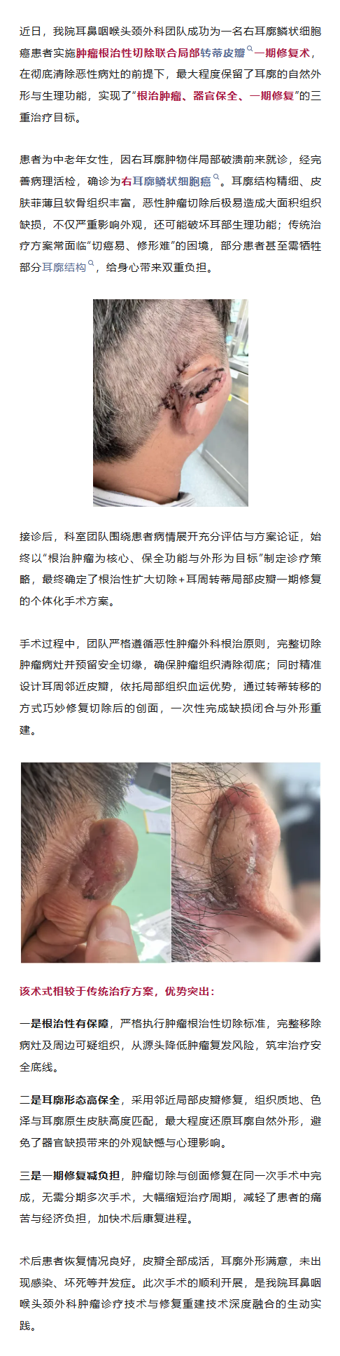 仁心精技 “根治+重建”，我院用一次手术为耳廓鳞状细胞癌患者完成三重治疗目标.png
